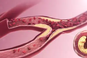 علت گرفتگی سه رگ اصلی قلب چیست؟