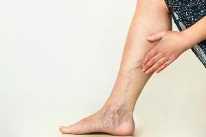 آشنایی با 31 روش درمان خانگی واریس پا+علائم و ویدئو