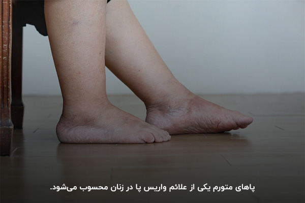 پاهای متورم و سنگین؛ یکی از نشانه‌های واریس پا در زنان
