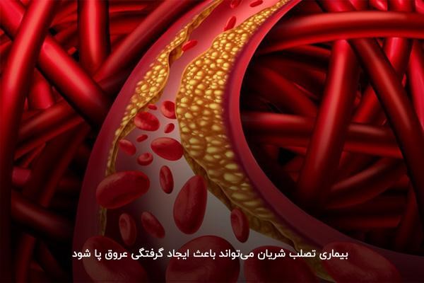 گرفتگی رگ پای چپ و راست بهدلیل بیماری تصلب شریان