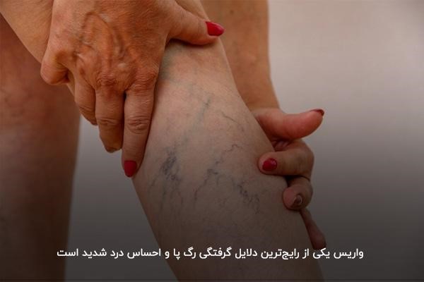 درمان گرفتگی رگ پای راست و چپ بهدلیل اختلال واریس