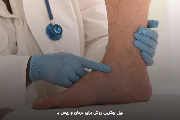 رگ‌های بیرون زده از عوارض واریس پا