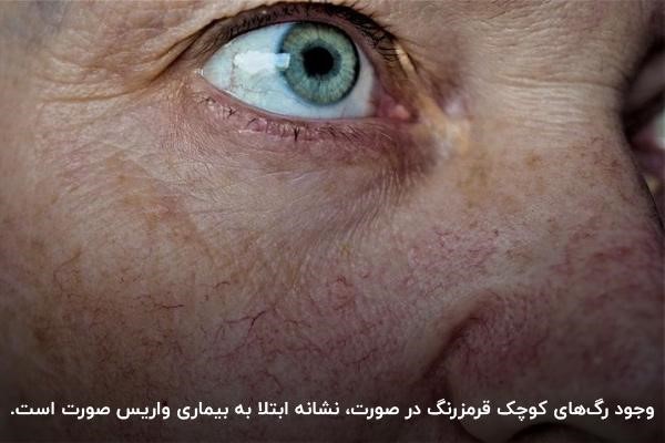 واریس صورت چیست؟ رگ های قرمز رنگ روی پوست صورت