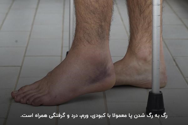کبودی، تورم و درد؛ شایع‌ترین علائم رگ به رگ شدن پا