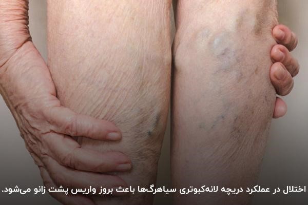 اختلال در عملکرد سیاهرگ‌های پا؛ علت واریس پشت زانو