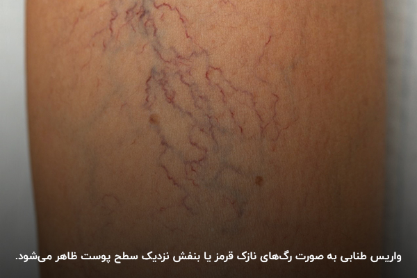 رگ های واریس طنابی به رنگ قرمز و بنفش