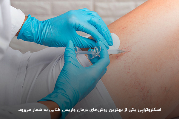 اشکلروتراپی؛یکی از بهترین روشهای درمان واریس طنابی