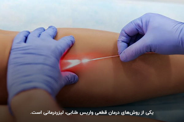 درمان واریس پا با لیزر؛ یکی از روشهای درمان واریس طنابی