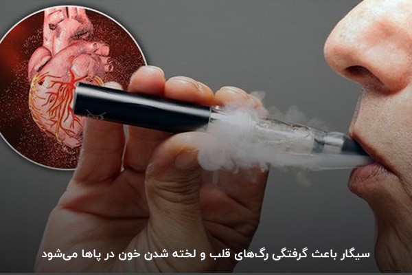 مصرف سیگار؛ دلیل گرفتگی رگ‌های پا و قلب 