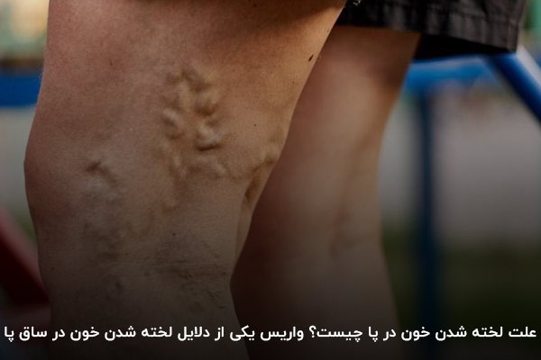 واریس؛ رایج‌ترین دلیل لختگی خون در پا