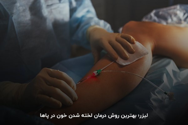 درمان لختگی خون پا با لیزر؛ روشی بدون درد و خونریزی