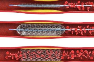 آنژیوپلاستی عروق کرونری قلب