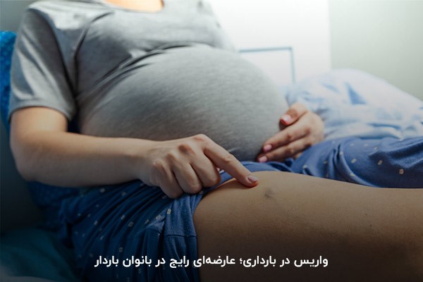 دلیل واریس در بارداری؛ افزایش مایعات بدن