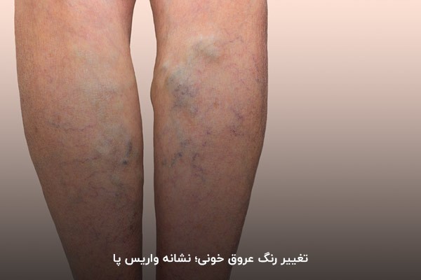 واریس؛ دلیل تغییر رنگ عروق پا