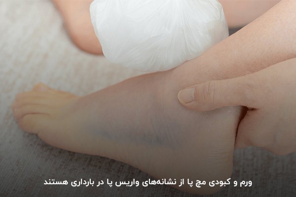 باد کردن مچ پا؛ یکی از نشانههای واریس در بارداری