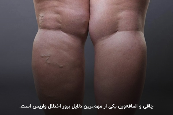 ابتلا به واریس پا به‌دلیل اضافه وزن و چاقی