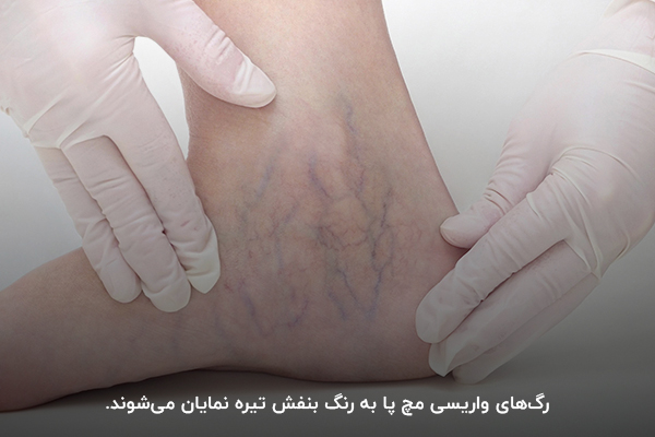 رگ‌های واریسی با رنگ بنفش تیره در ناحیه مچ پا