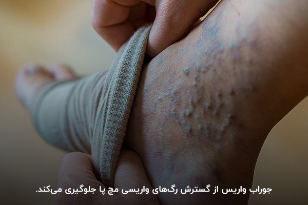 استفاده از جوراب واریس برای درمان واریس مچ پا