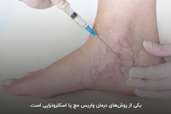 اسکلروتراپی؛ یکی از بهترین روش‌های درمان واریس مچ پا