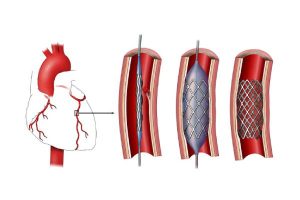 مراحل انجام آنژیوپلاستی برای سرخرگ کرونری