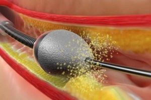 خطرات آنژیو پلاستی