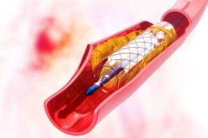 تفاوت آنژیو پلاستی و آنژیو گرافی