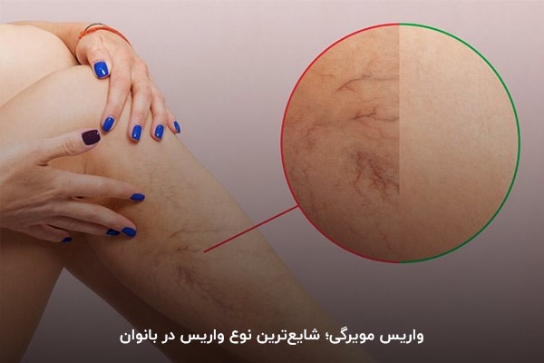 واریس مویرگی؛ رایج‌ترین نوع واریس