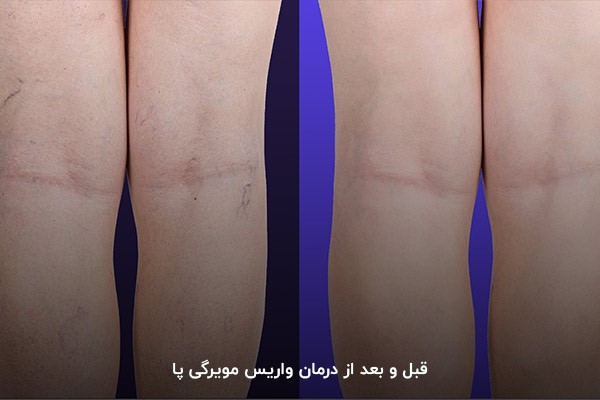 درمان واریس مویرگی با استفاده از لیزر و جوراب واریس