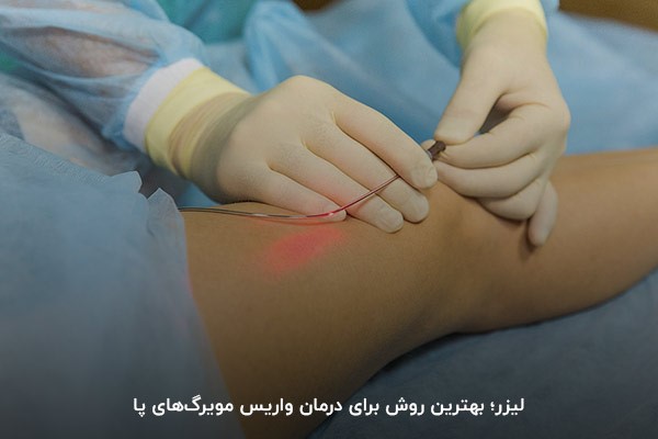درمان واریس مویرگی با لیزر؛ رفع واریس به‌صورت دائمی
