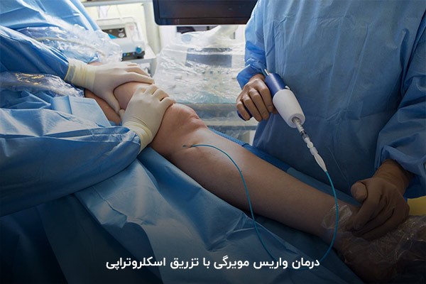 تزریق محلول اسکلروزانت؛ یکی از روش‌های درمان واریس مویرگی