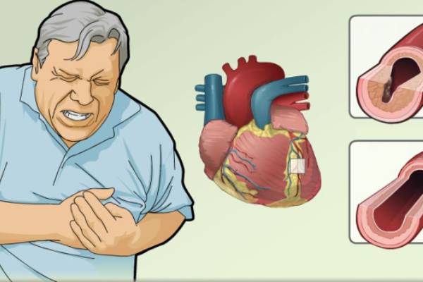 روش‌های تشخیص درد قلب عصبی: علائم درد قلب عصبی